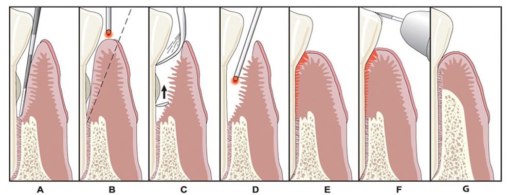 Steps of the LANAP procedure for gum disease treatment.