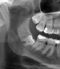 Impacted wisdom teeth ready for extraction.